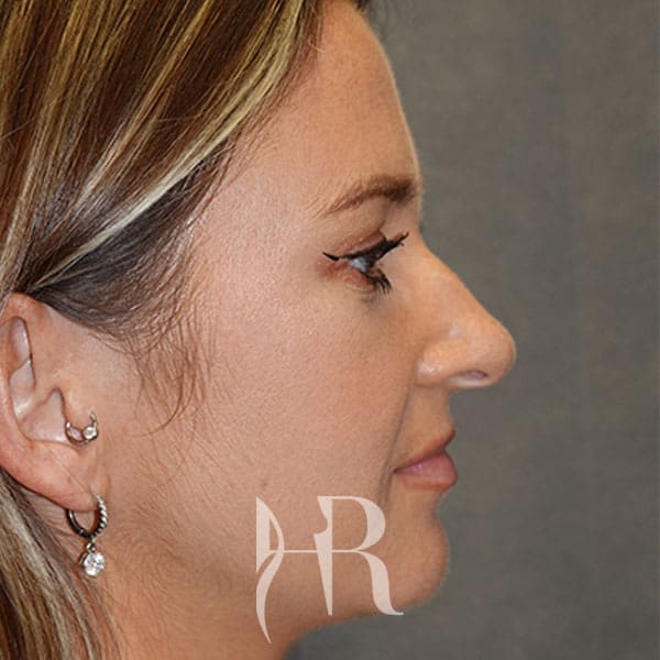 HR Plastic Surgery - Nose Reshaping (Rhinoplasty) patient before 16
