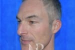 HR Plastic Surgery - Nose Reshaping (Rhinoplasty) patient before 2