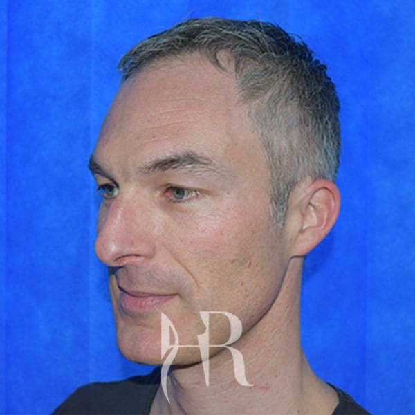 HR Plastic Surgery - Nose Reshaping (Rhinoplasty) patient before 2