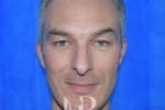 HR Plastic Surgery - Nose Reshaping (Rhinoplasty) patient before 3