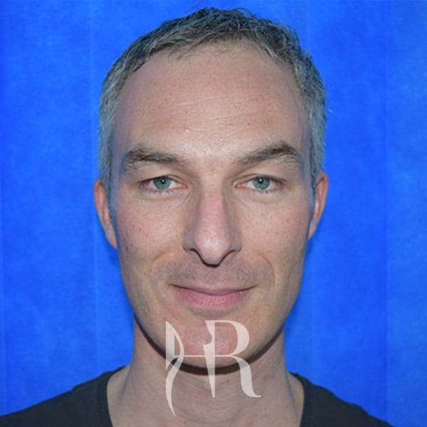 HR Plastic Surgery - Nose Reshaping (Rhinoplasty) patient before 3