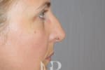 HR Plastic Surgery - Nose Reshaping (Rhinoplasty) patient before 4