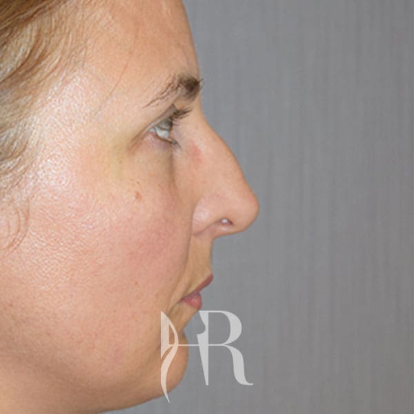HR Plastic Surgery - Nose Reshaping (Rhinoplasty) patient before 4