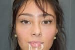 HR Plastic Surgery - Nose Reshaping (Rhinoplasty) patient before 5