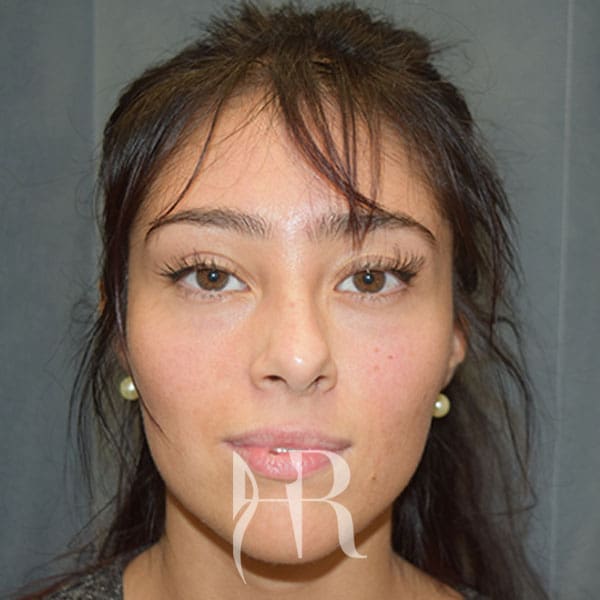 HR Plastic Surgery - Nose Reshaping (Rhinoplasty) patient before 5