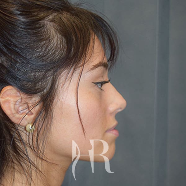HR Plastic Surgery - Nose Reshaping (Rhinoplasty) patient before 6