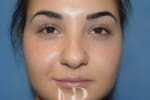 HR Plastic Surgery - Nose Reshaping (Rhinoplasty) patient before 7