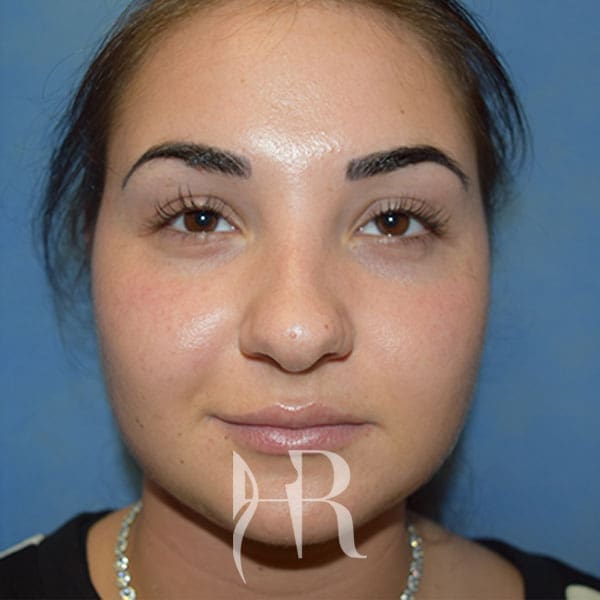 HR Plastic Surgery - Nose Reshaping (Rhinoplasty) patient before 7