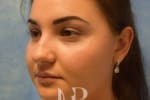 HR Plastic Surgery - Nose Reshaping (Rhinoplasty) patient before 8