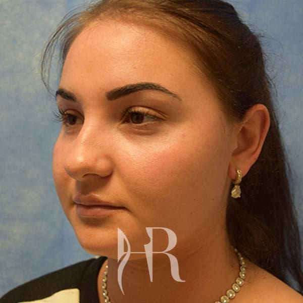 HR Plastic Surgery - Nose Reshaping (Rhinoplasty) patient before 8
