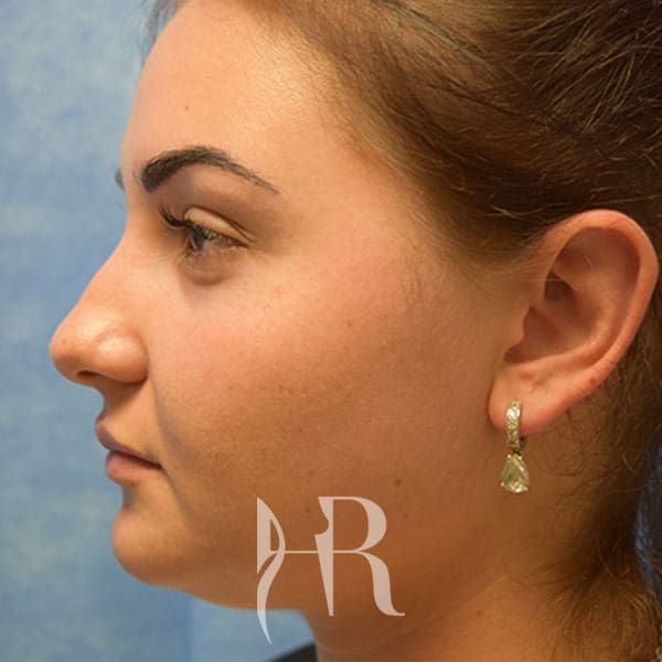 HR Plastic Surgery - Nose Reshaping (Rhinoplasty) patient before 9