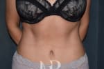 HR Plastic Surgery - Tummy Tuck patient after 1