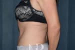 HR Plastic Surgery - Tummy Tuck patient after 2