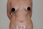 HR Plastic Surgery - Tummy Tuck patient before 1