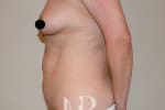 HR Plastic Surgery - Tummy Tuck patient before 2