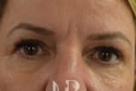 HR Plastic Surgery - Eyelid Surgery (Blepharoplasty) patient after 2