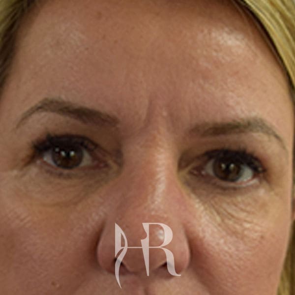 HR Plastic Surgery - Eyelid Surgery (Blepharoplasty) patient after 2
