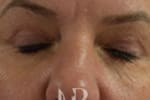 HR Plastic Surgery - Eyelid Surgery (Blepharoplasty) patient after 3