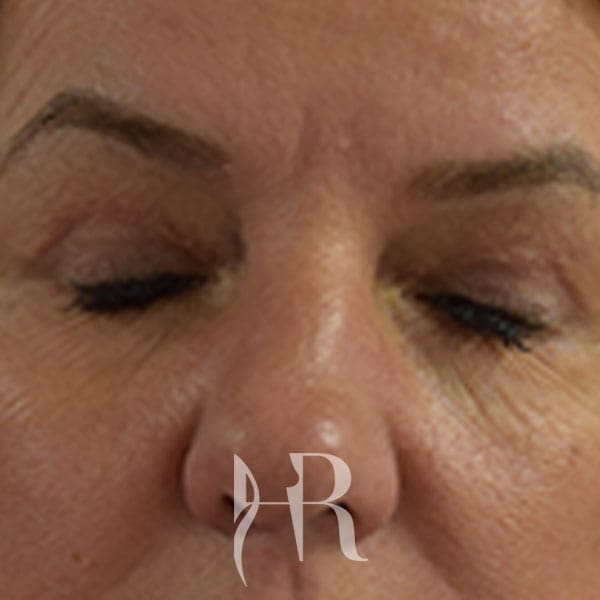 HR Plastic Surgery - Eyelid Surgery (Blepharoplasty) patient after 3