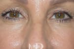 HR Plastic Surgery - Eyelid Surgery (Blepharoplasty) patient after 4