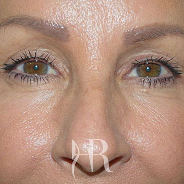HR Plastic Surgery - Eyelid Surgery (Blepharoplasty) patient after 4