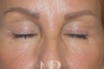 HR Plastic Surgery - Eyelid Surgery (Blepharoplasty) patient after 5