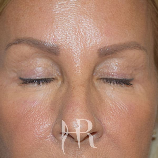 HR Plastic Surgery - Eyelid Surgery (Blepharoplasty) patient after 5