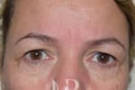 HR Plastic Surgery - Eyelid Surgery (Blepharoplasty) patient before 2