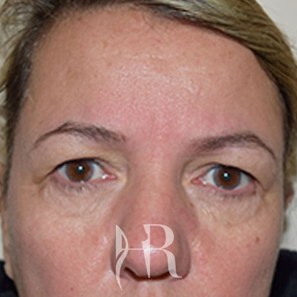 HR Plastic Surgery - Eyelid Surgery (Blepharoplasty) patient before 2