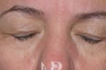 HR Plastic Surgery - Eyelid Surgery (Blepharoplasty) patient before 3