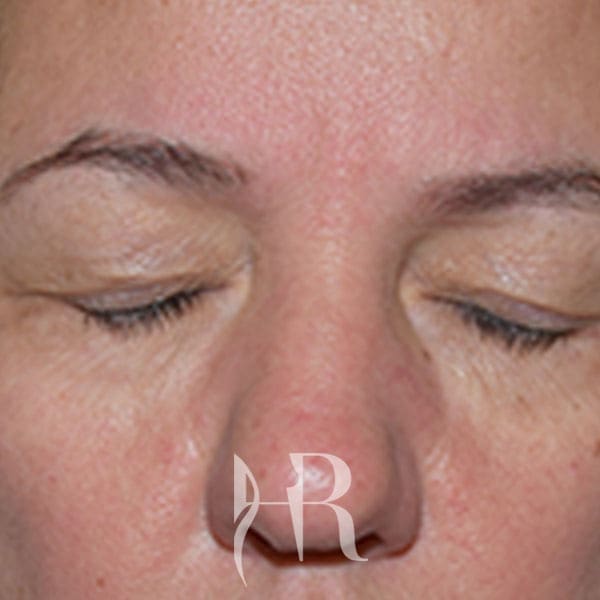 HR Plastic Surgery - Eyelid Surgery (Blepharoplasty) patient before 3