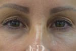 HR Plastic Surgery - Eyelid Surgery (Blepharoplasty) patient before 4
