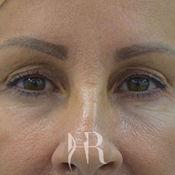 HR Plastic Surgery - Eyelid Surgery (Blepharoplasty) patient before 4