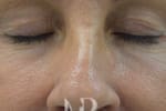 HR Plastic Surgery - Eyelid Surgery (Blepharoplasty) patient before 5