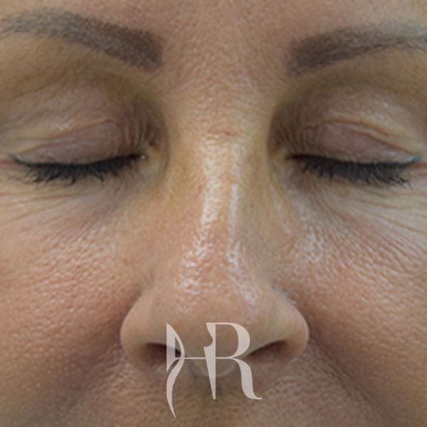 HR Plastic Surgery - Eyelid Surgery (Blepharoplasty) patient before 5