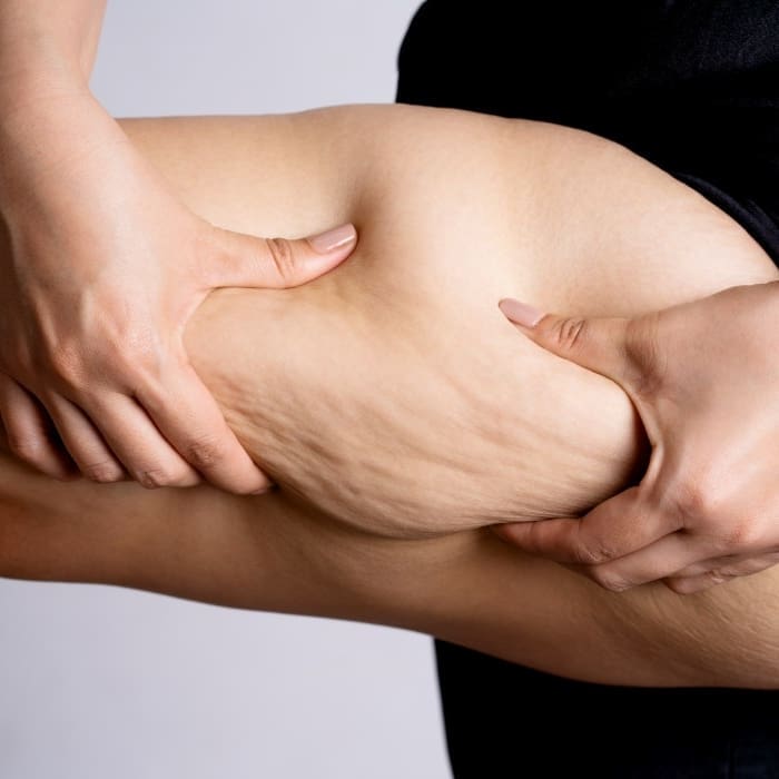 HR Plastic Surgery - How To Tighten Loose Skin On Inner Thighs?