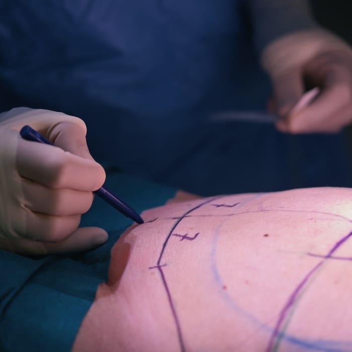 HR Plastic Surgery - How much does it cost for a tummy tuck?