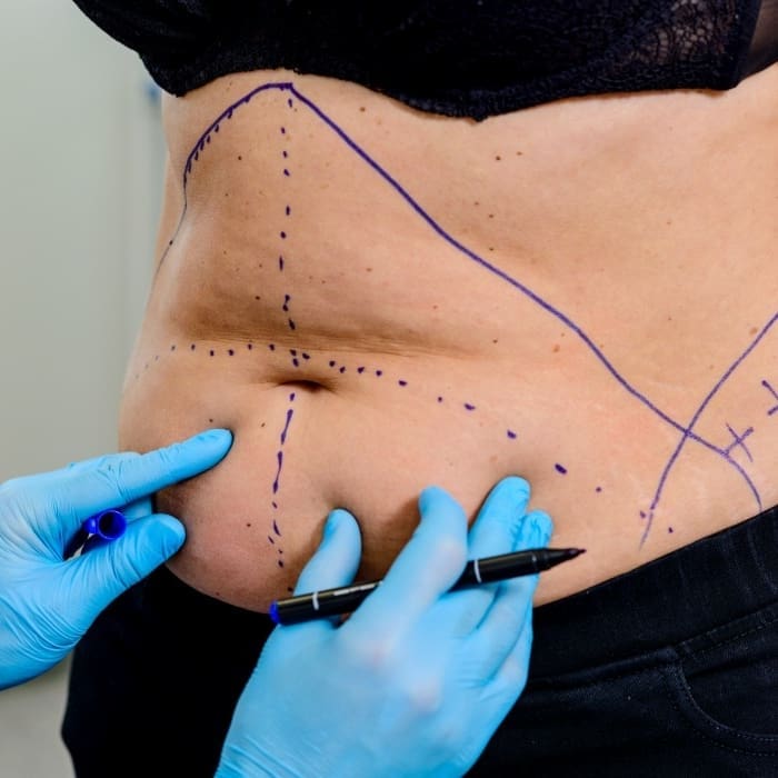 HR Plastic Surgery - How much does it cost for a tummy tuck?