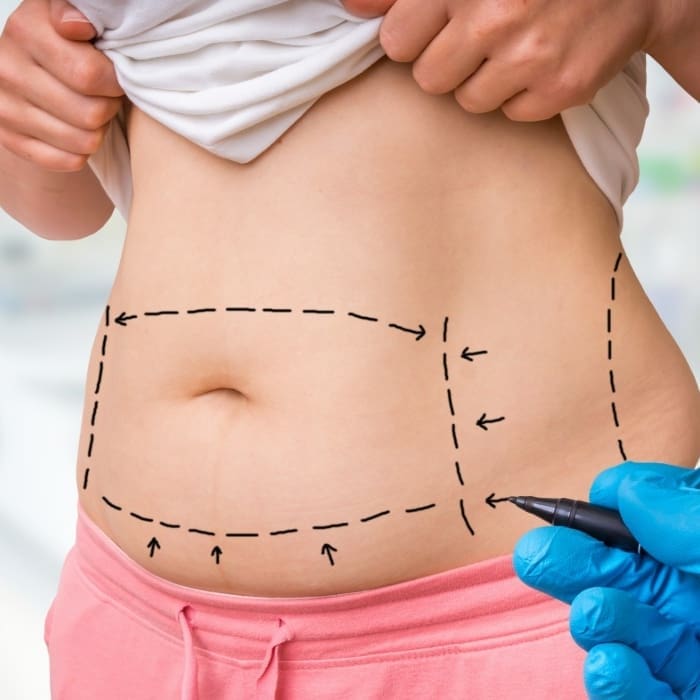 HR Plastic Surgery - How much does it cost for a tummy tuck?